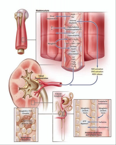 Hội chứng tiêu cơ vân cấp