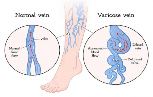 Thông tin bạn cần biết về bệnh suy giãn tĩnh mạch chi dưới