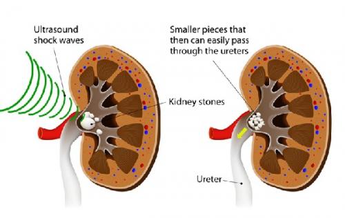 Phương pháp tán sỏi trong điều trị sỏi thận